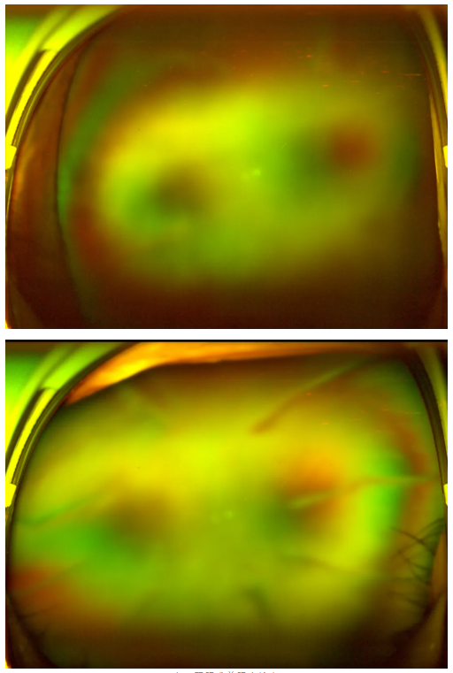 糖尿病視網(wǎng)膜病變